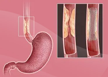 Esophageal Stenting